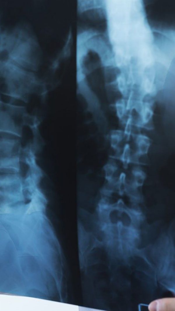 degenerative spinal column